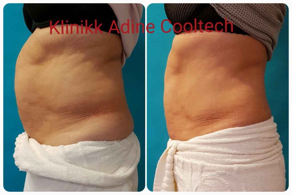 for-og-etterbilder_01-1024x683