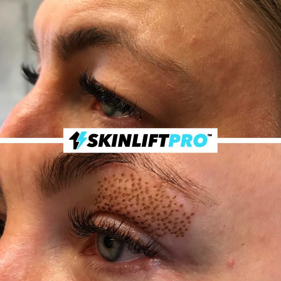 skinliftpro_01-1024x1024